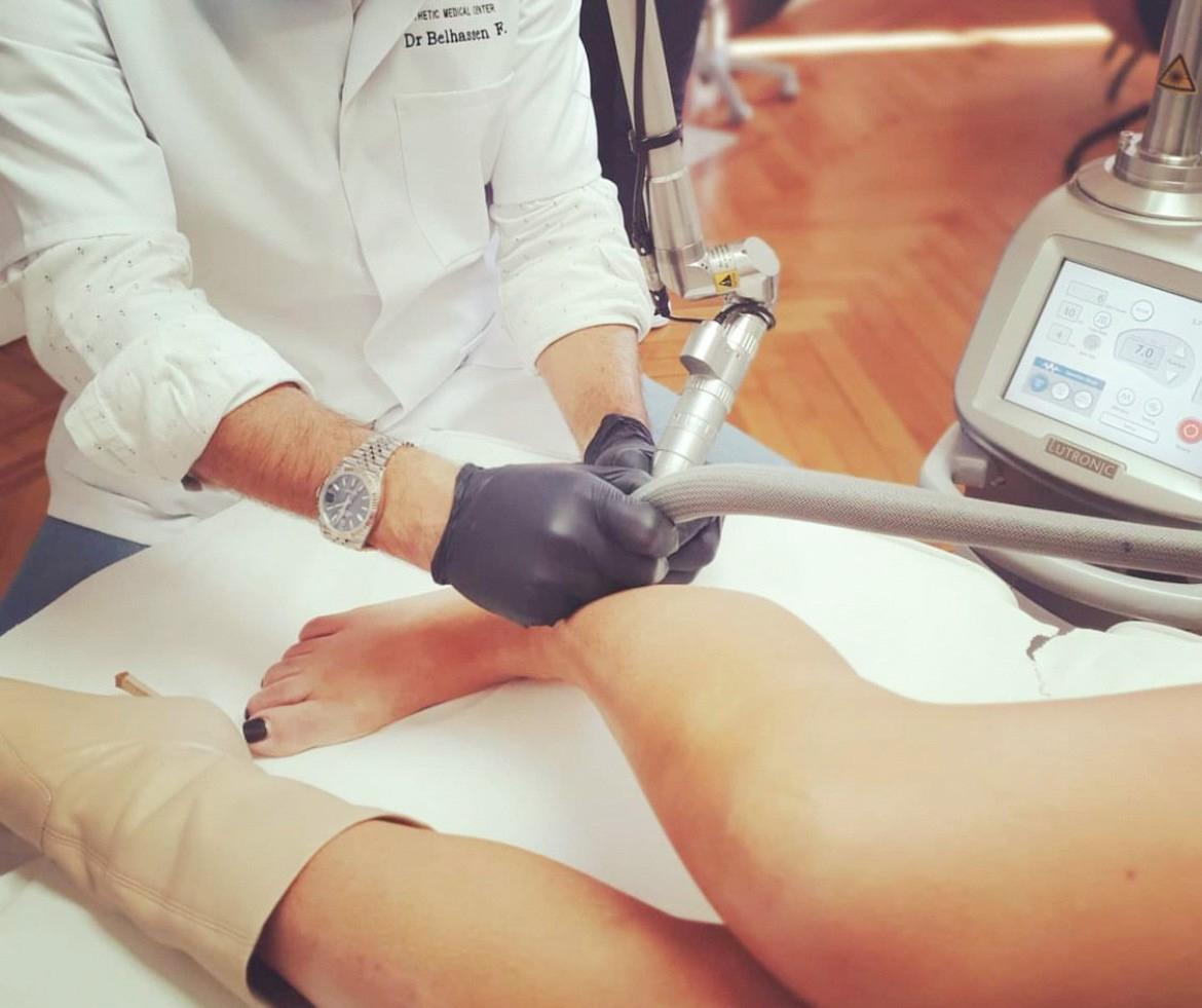 Détatouage au laser à Nice - Dr Belhassen