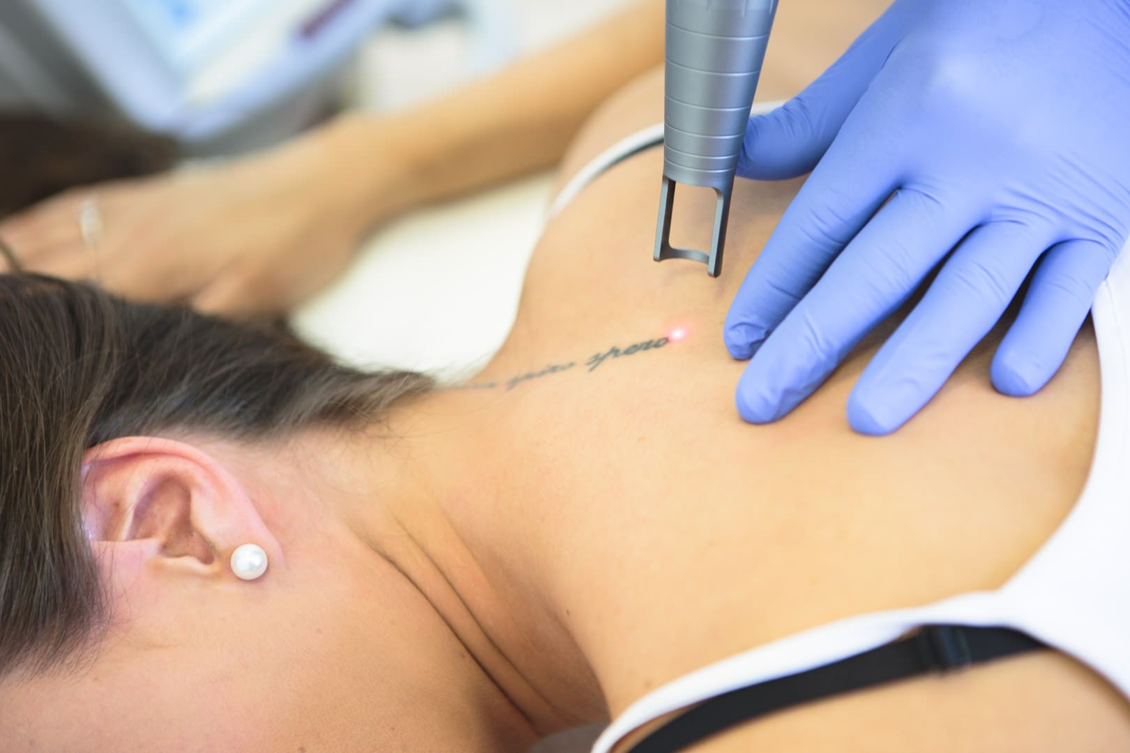 Séance détatouage laser à Nice - Dr Belhassen