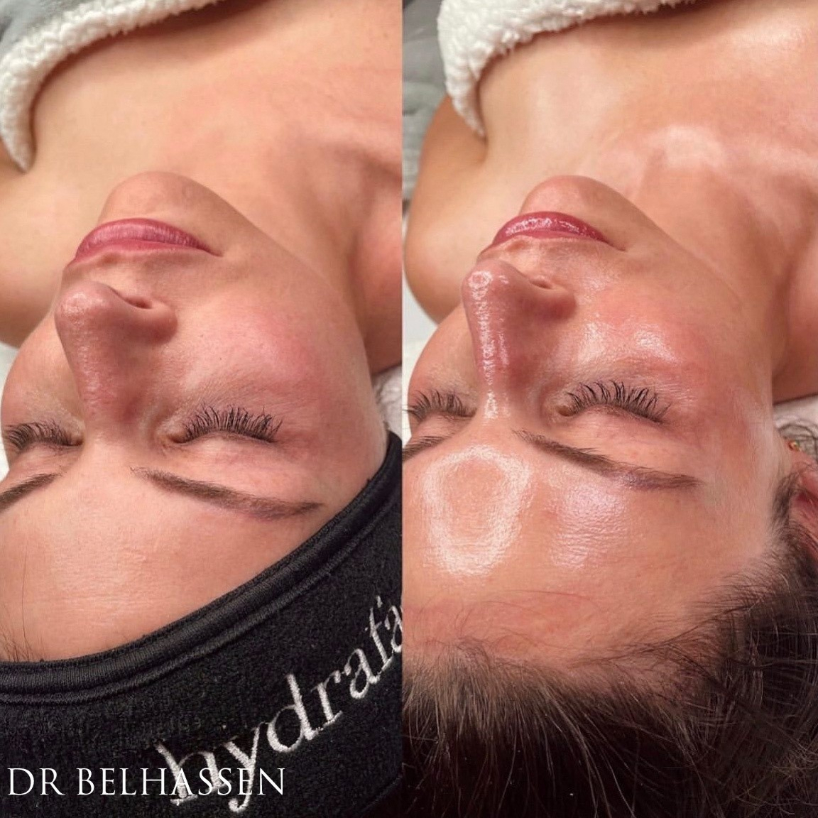 Soin hydrafacial à Nice - Dr Belhassen