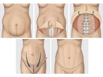 abdominoplastie nice