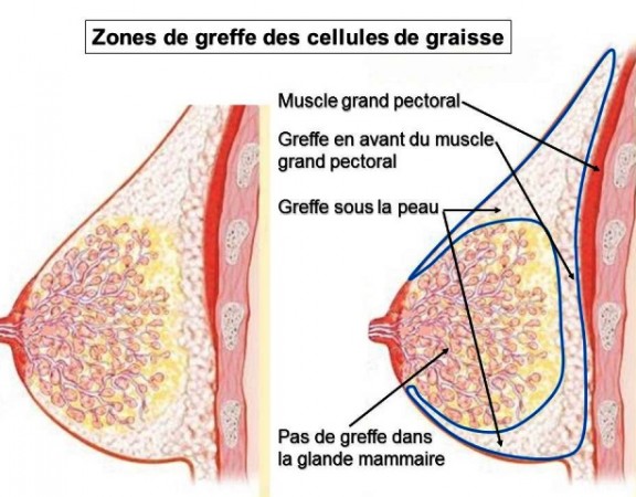lipofilling mammaire nice