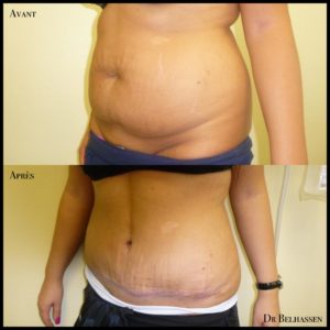 Abdominoplastie -photos avant et après