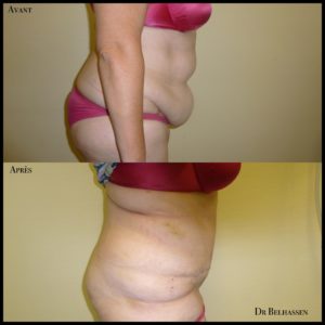 Abdominoplastie -chirurgie de la silhouette