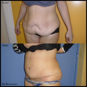 Abdominoplastie -chirurgie de la silhouette