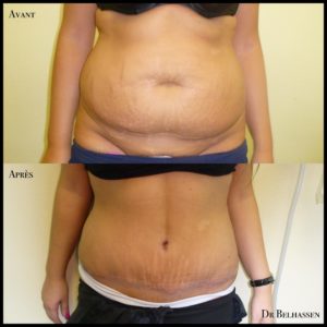 Abdominoplastie-min