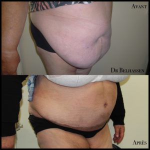 Abdominoplastie-min