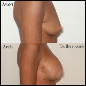 Prothèse mammaire chez Docteur Belhassen chirurgien esthétique à Nice