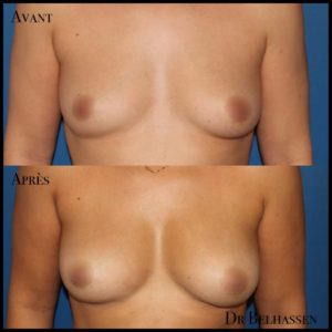 Lipofiling de seins-Dr Belhassen