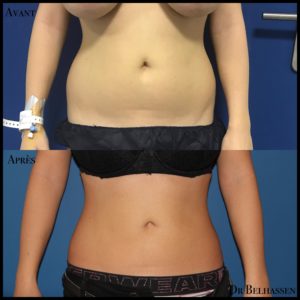 Liposuccion des fesses -chirurgie de la silhouette