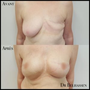 Reconstruction mammaire chez docteur Belhassen