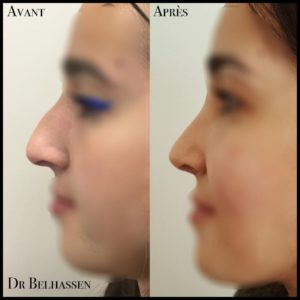 Rhinoplastie 2-min