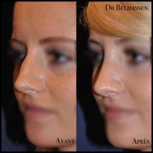 rhinoplastie-chirurgie-visage Dr Belhassen