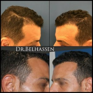 Greffe de cheveux-photos avant-après médecine et chirurgie du visage
