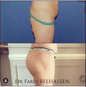 Photos avant-après chirurgie de la silhouette-Dr Farès Belhassen