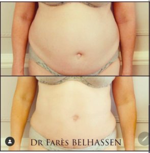 Abdominoplastie-Photos avant-après chirurgie de la silhouette