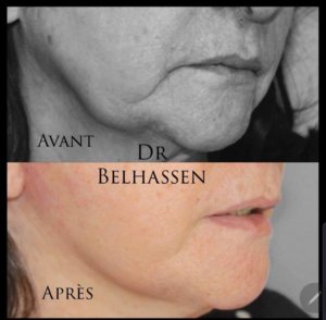 photos avant-après médecine et chirurgie du visage chez Docteur Farès Belhassen