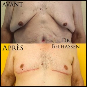 Abdominoplastie-Photos avant-après chirurgie de la silhouette