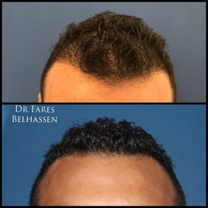 Photos avant-après-Greffe de cheveux-Dr Belhassen-médecine esthétique à Nice