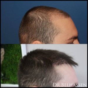 Greffe de cheveux-Photos avant-après médecine et chirurgie du visage