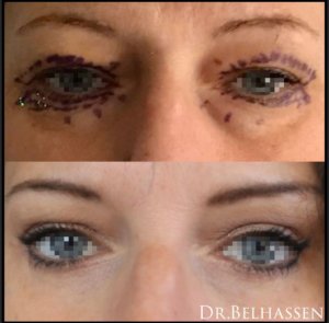 Blépharoplastie Dr Belhassen Chirurgien esthétique à Nice