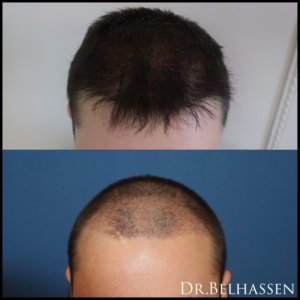 Greffe de cheveux-Photos avant-après médecine et chirurgie du visage