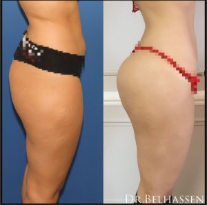 Lipofilling des fesses - prothèse des fesses chez Dr Belhassen