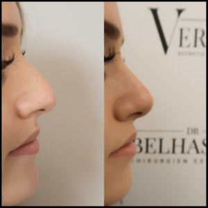 Rhinoplastie-photos avant-après médecine et chirurgie du visage chez Docteur Farès Belhassen