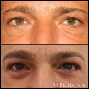 Blépharoplastie-photos avant-après médecine et chirurgie du visage chez Docteur Farès Belhassen