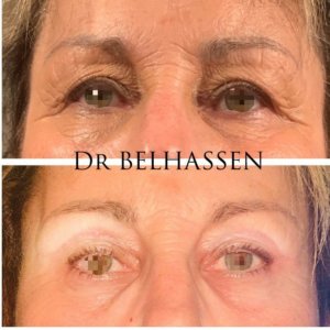 Blépharoplastie Dr Belhassen