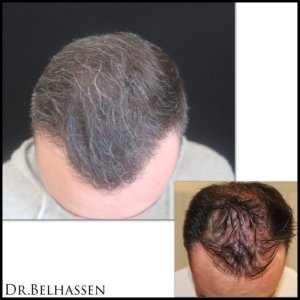 Greffe de cheveux-Dr Belhassen