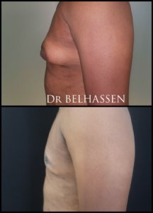 Gynécomastie-photos avant et après chez docteur Belhassen