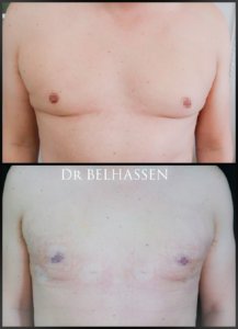 Gynécomastie-photos avant et après chez docteur Belhassen