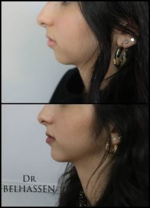 Génioplastie-chirurgie du visage chez Dr Belhassen