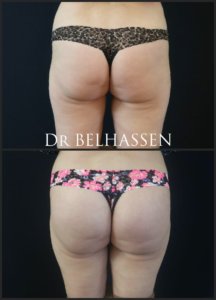 Lipofilling des fesses prothèse des fesses-Dr Belhassen