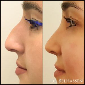 Rhinoplastie-photo avant et après