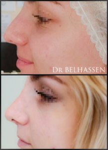 Rhinoplastie Dr Belhassen