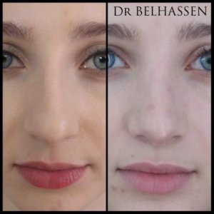 Rhinoplastie Dr Belhassen