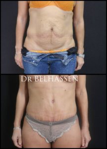 abdominoplastie photos avant et après