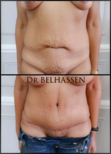 abdominoplastie photos avant et après une séance chez docteur Belhassen