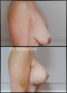 mastopexie photos avant et après chirurgie mammaire