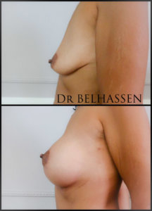 prothèse mammaire-chirurgie mammaire