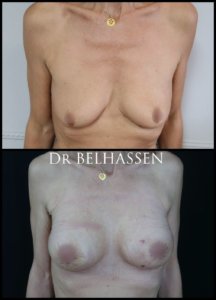 mastopexie photos avant et après chirurgie mammaire