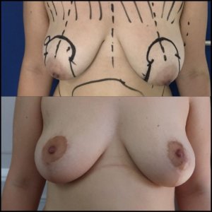 reconstruction mammaire-Docteur Belhassen à Nice