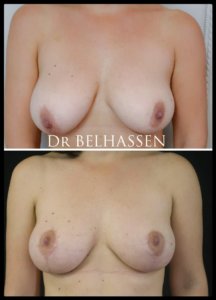 réduction mammaire-photos avant et après chez docteur Belhassen