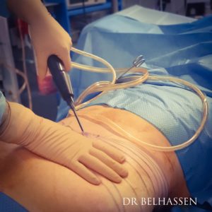 Liposuccion avec nouvelle technologie le LIPOMATIC -Dr Belhassen