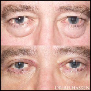 Blépharoplaste