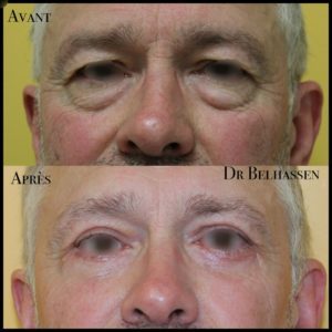 Blépharoplaste