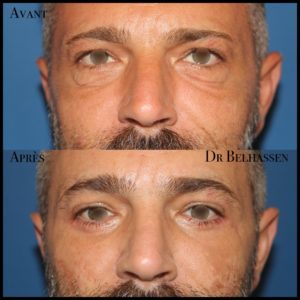 Blépharoplaste