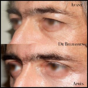 Blépharoplaste