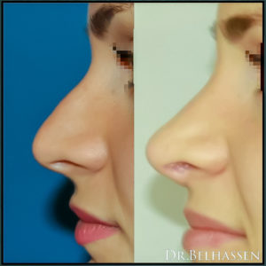 Rhinoplastie